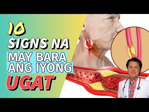 10 Senyales na May Bara ang iyong Ugat. By Doc Willie Ong