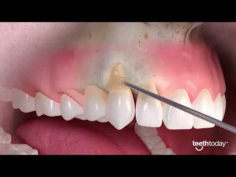 Gum Recession Treatment | Advanced Dental Implant and TMJ Center