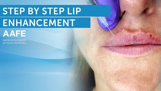 Lip Filler Tutorial + Post Care Procedure