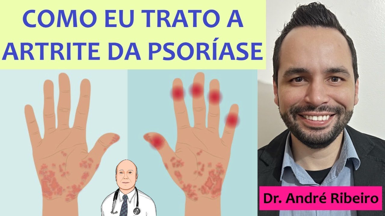 Os segredos do moderno tratamento da artrite na psoríase: alívio das dores e retorno à vida normal
