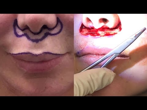 download lagu mp3 mp4 Samantha Before And After Facial Surgery, download lagu Samantha Before And After Facial Surgery gratis, unduh video klip Samantha Before And After Facial Surgery