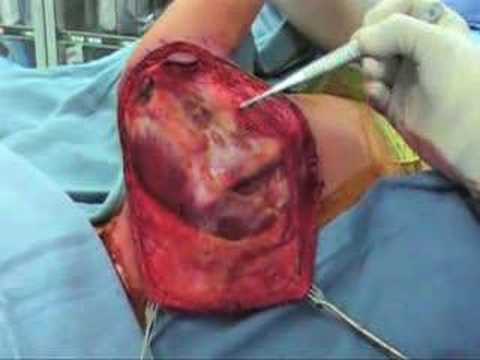 Prosthesis Of Scapula Radical Removal Due To Sarcoma Of The Ewing - Part 1