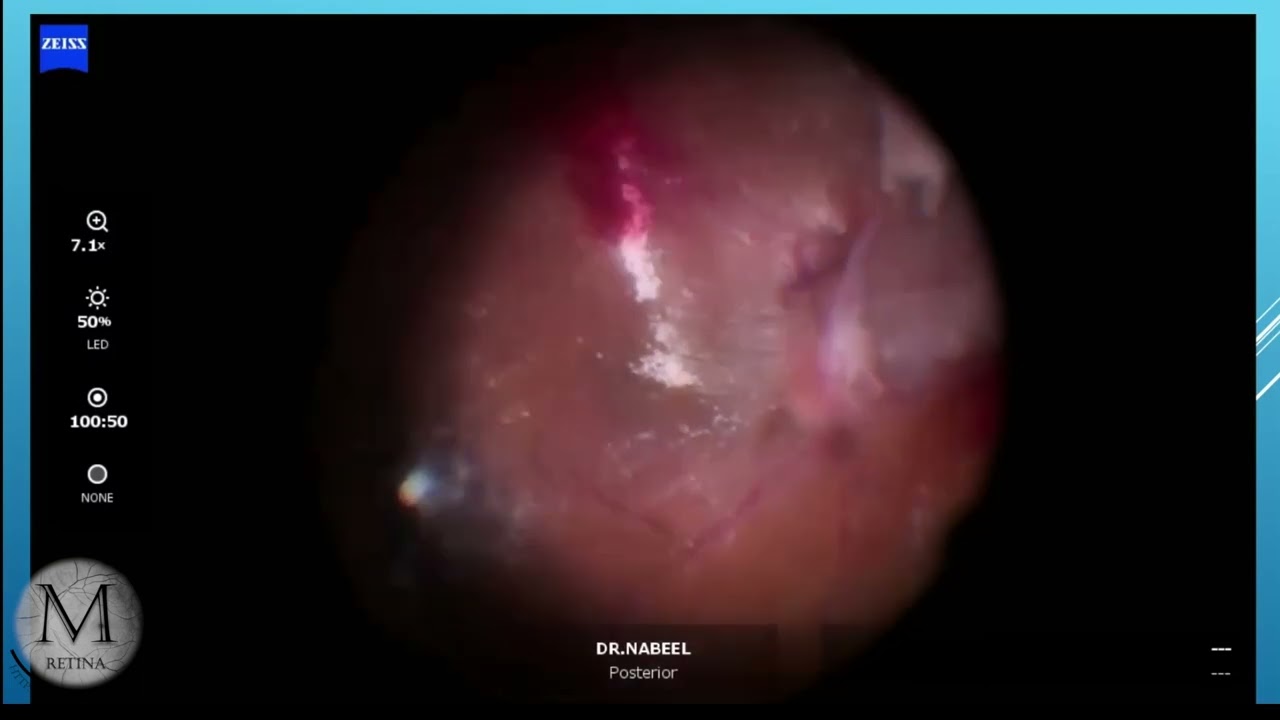 Surgical Management of Tractional Retinal Detachment
