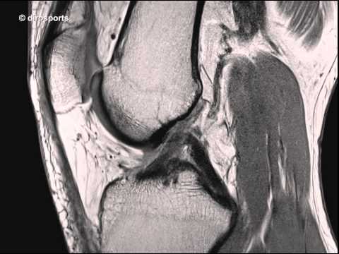 Arthrose des Knies, wie Bewertungen zu behandeln Dikloberl Schmerzen im Nacken