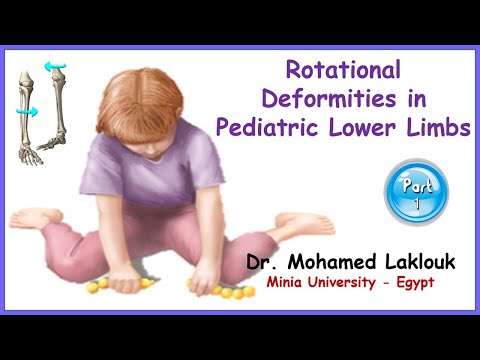 Rotational Deformities in Pediatric Lower Limbs (Part 1) | Dr. Mohamed Laklouk - Video - Orthobullets