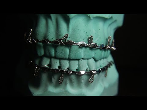 Placement of Arch bar