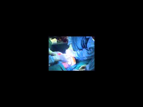 Trattamento terapeutico di unarticolazione dellanca Displasia dellanca negli adulti sintomi di trattamento