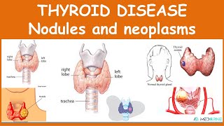 Thyroid Diseases: Nodules and Neoplasms