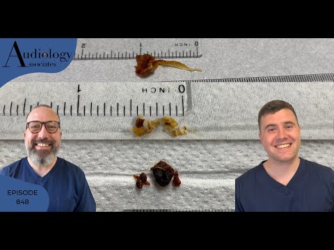 GOLDEN EAR WAX WITH SKIN RIBBON TAIL & 2 MORE WAX REMOVALS - EP848