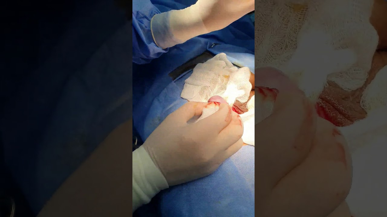 عملية رفع ورم حميد من الخصية // excision of epidermoid cyst from the testis