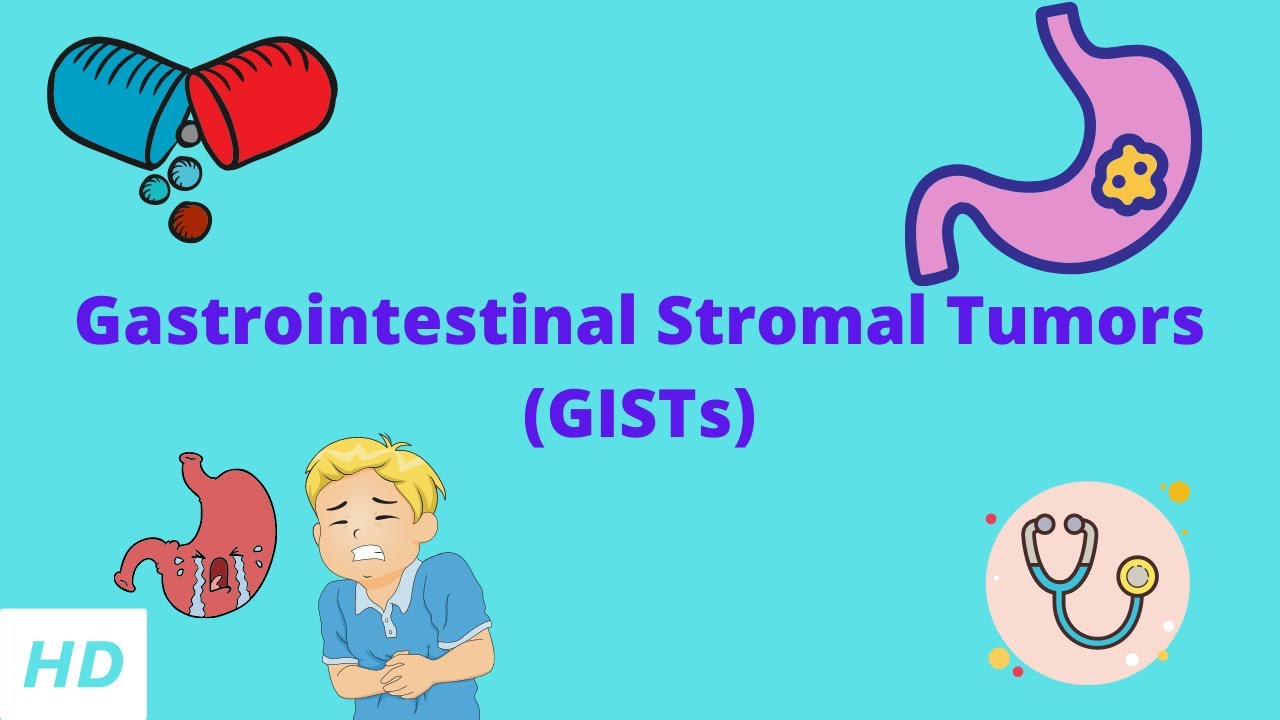 Gastrointestinal Stromal Tumor (GISTs), Causes, Signs and Symptoms, Diagnosis and Treatment,