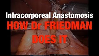 Download Lagu Intracorporeal Anastomosis - How Dr. Garrett Friedman Does It Thumbnail