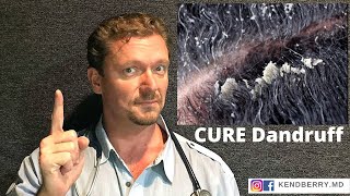 CURE Dandruff (And keep it Gone FOREVER) Seborrhoeic Dermatitis