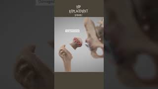 Hip replacement surgery 3D animation short video || #surgery #video