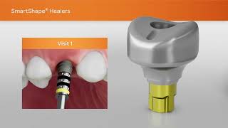 A More Efficient Implant Restoration Workflow | SmartShape Healers from BioHorizons