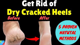 How do you Get Rid of Dry Cracked Heels Fast? | Home Remedy to Remove Cracked Heels Fast