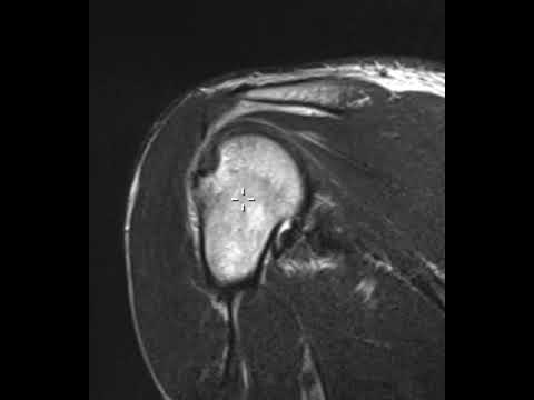 Rotator cuff tear