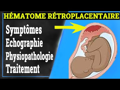 HÉMATOME RÉTROPLACENTAIRE: Symptômes, Causes, Traitement..| Gynécologie