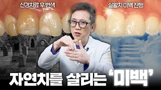 별도 보철치료 없이 손상된 치아를 하얗게 만드는 방법