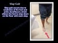 Slap Gait Steppage Gait Foot Drop Everything You Need To Know Dr Nabil Ebraheim
