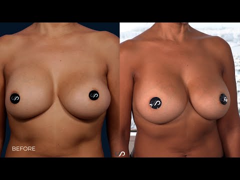 L.A. Natural Breast Augmentation and Lift | Los Angeles