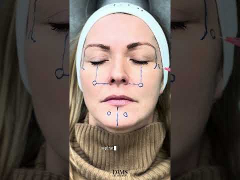 Profhilo Injection Process Explained by a Doctor - Watch Now| - DrMedispa