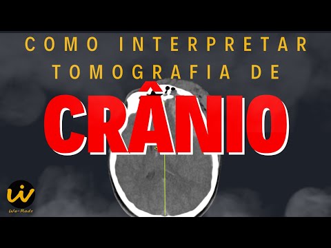 Como Interpretar uma TOMOGRAFIA COMPUTADORIZADA de CRÂNIO
