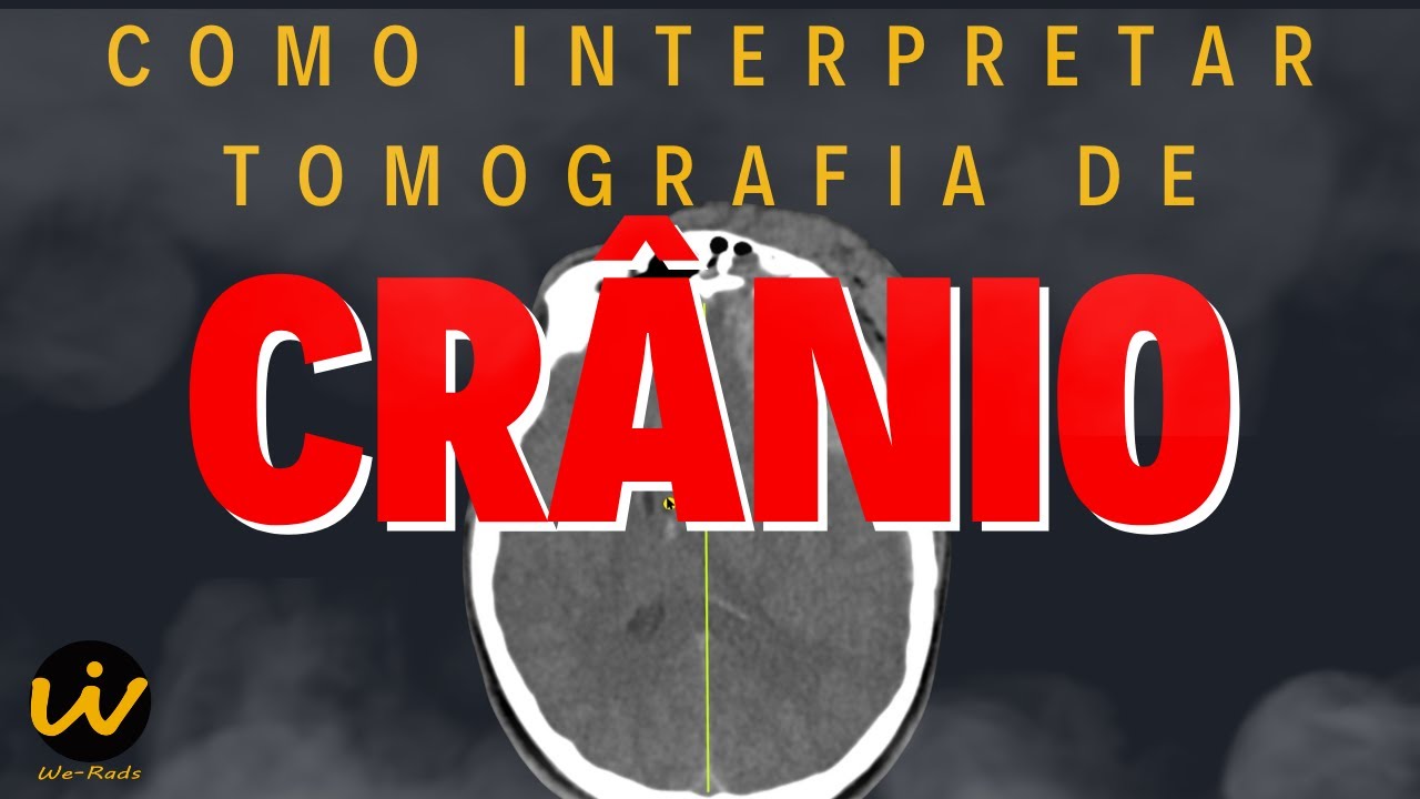 Como Interpretar uma TOMOGRAFIA COMPUTADORIZADA de CRÂNIO