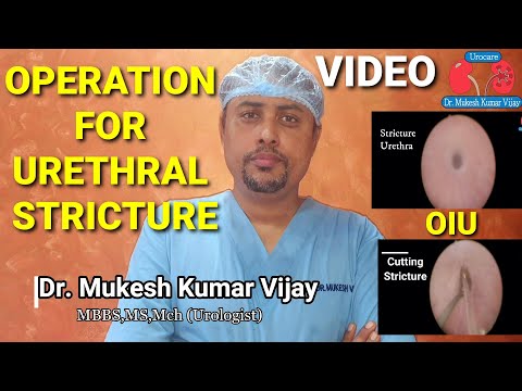 Cystoscopy & Urethrotomy Operation | Optical Internal Urethrotomy OIU/VIU Stricture Urethra Surgery