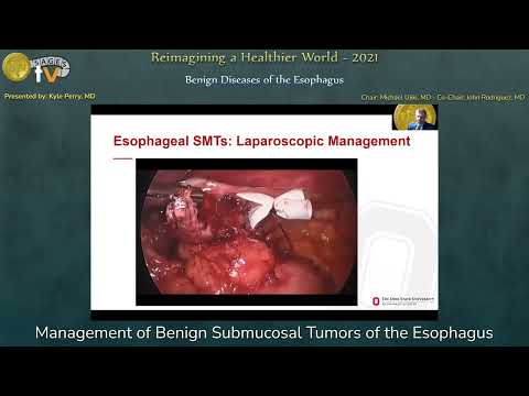 Management of Benign Submucosal Tumors of the Esophagus
