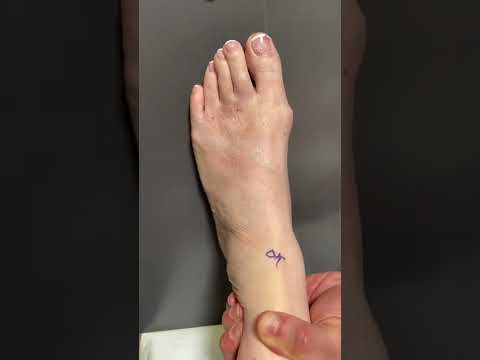 Foot receive extreme makeover
