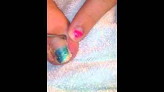 Ingrown Toenail Relief