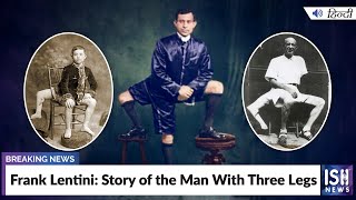 Frank Lentini: Story of the Man With Three Legs