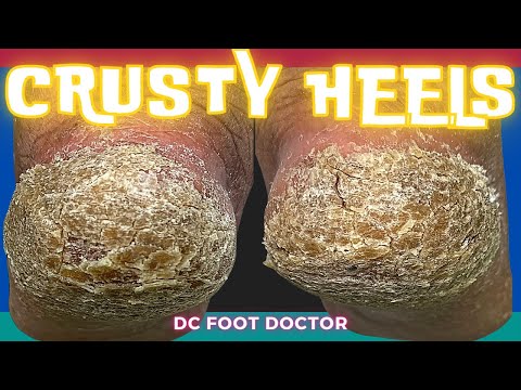 Crusty Heels: Removing Thick Callus and Scales From the Heels