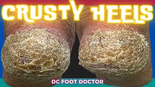 Crusty Heels: Removing Thick Callus and Scales From the Heels