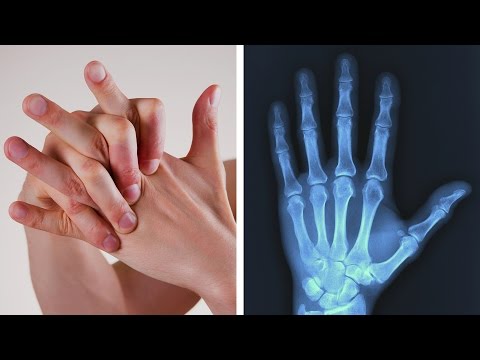 Hüft-Rückenschmerzen nach der Operation Gehen Schmerzen im Hüftgelenk in Coxarthrose