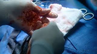 Code Black Ep- 17 Part- 10/12 //Brody critical scene code black// Cameron Boyce critical scene video