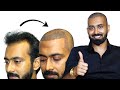 Shashank’s Hair Transplant Review | Hair Transplant Cost In Hyd |