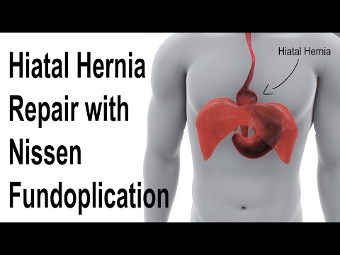 Hiatal Hernia Repair with Nissen Fundoplication to Treat Reflux Animation