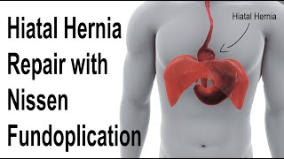 Hiatal Hernia Repair with Nissen Fundoplication to Treat Reflux Animation