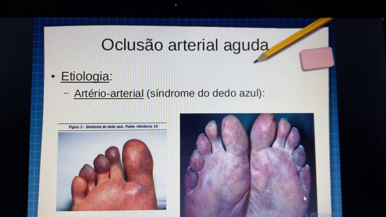 Aula Oclusão Arterial Aguda
