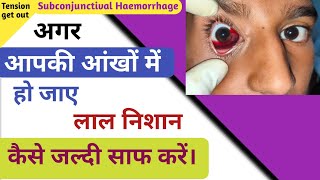 Red spot in eye| subconjunctival hemorrhage treatment| Tension get out