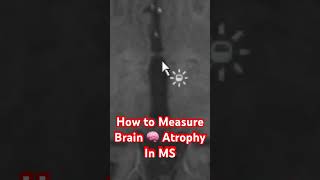 Poor Man&#39;s Way to Measure MS Brain 🧠 Atrophy (shrinkage)