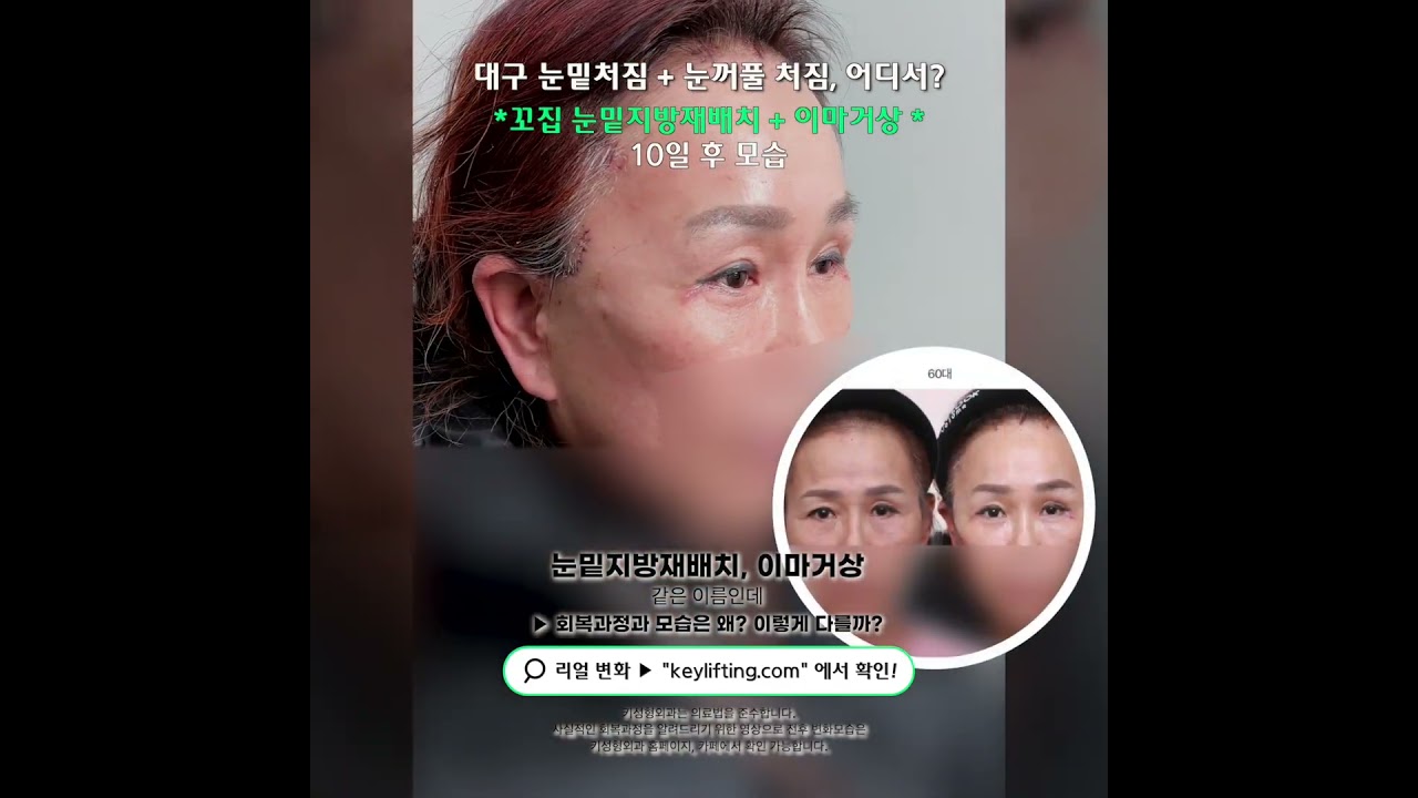 60대의 눈밑지방재배치, 이마거상 10일 후 모습