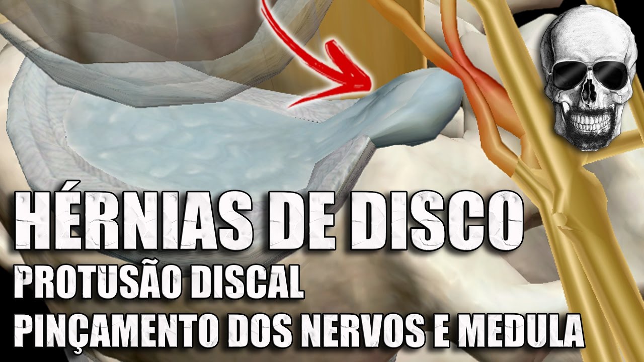Vídeo Aula 155 | Anatomia Humana | Coluna Vertebral: O que é hérnia de disco e protusão discal?