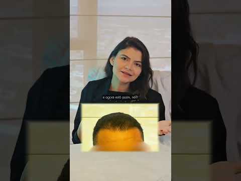 Cebelo Crespo: Entenda tudo com a Dra. Lara Antunes  - Transplante Capilar em Juazeiro do Norte