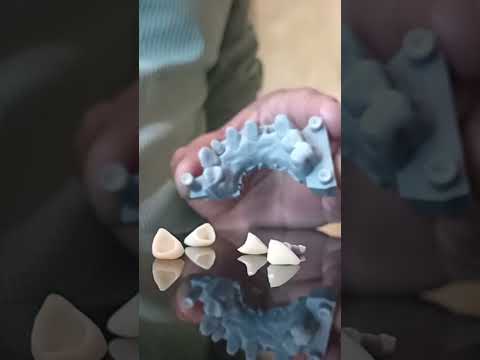 Coronas Dentales de alta estética.