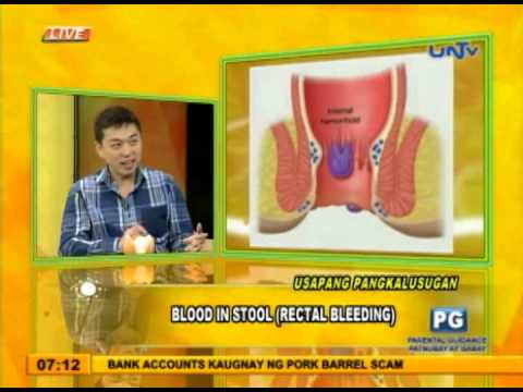 Blood in your stool? Know why.