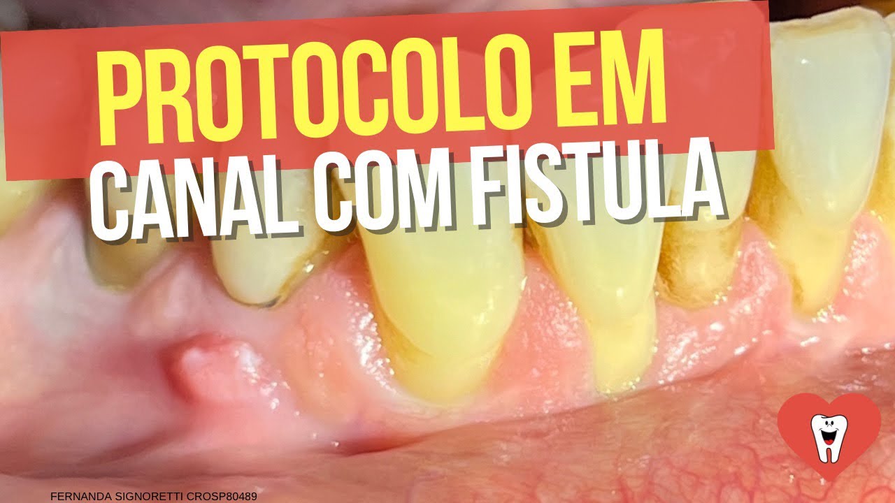 COMO NÃO ERRAR AO TRATAR O CANAL DE UM DENTE COM FÍSTULA - Endolovers
