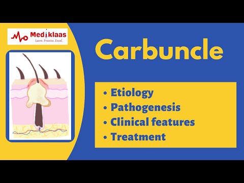 Carbuncle: The cluster of boils | General Surgery | Mediklaas